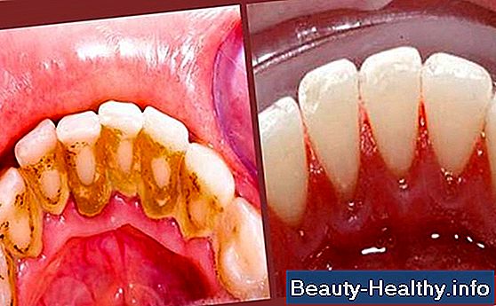 Cómo eliminar la placa de los dientes de forma natural