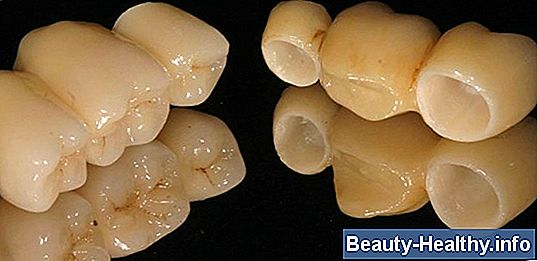 C贸mo hacer cemento dental