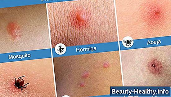 C贸mo hacer que las picaduras de garrapata dejen de picar