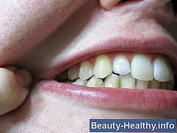 Cómo hacer una dentadura superior más cómoda
