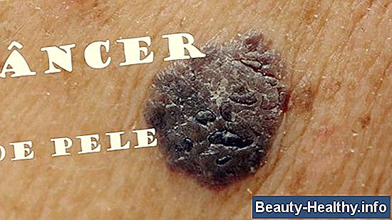 Cómo identificar tipos de cáncer de piel