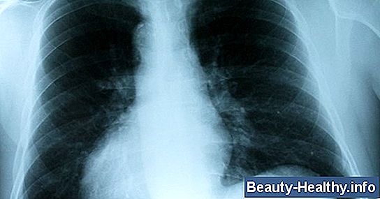 C贸mo limpiar los pulmones de la flema