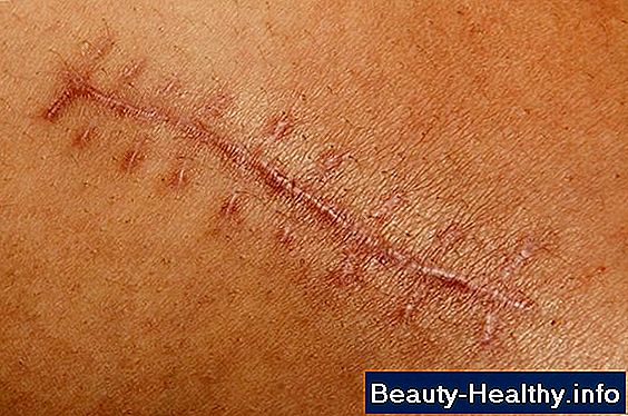 C贸mo quitar Dermabond de la piel