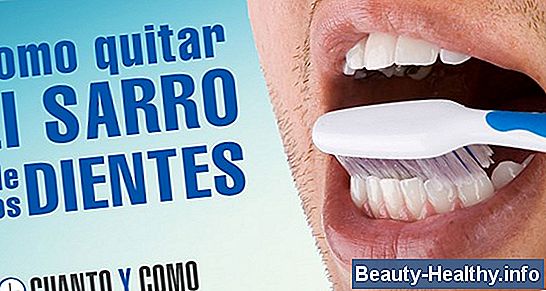 C贸mo quitar el sarro pesado de los dientes