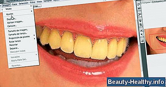 C贸mo quitar los dientes dorados