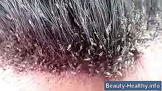 C贸mo quitar los piojos de los cascos
