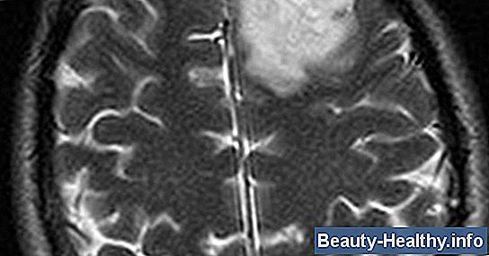 C贸mo reconocer los s铆ntomas de un tumor cerebral