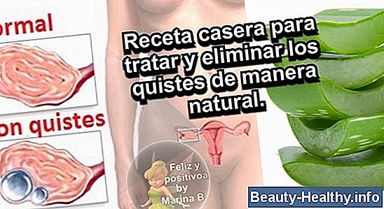 C贸mo reducir los quistes de fibrosis naturalmente