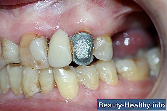 C贸mo reparar los dientes delanteros desconchados