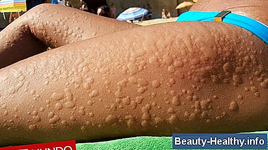 C贸mo tratar el edema en las piernas