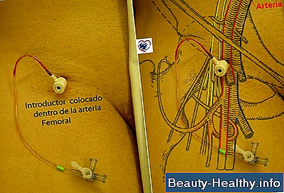C贸mo tratar la vasoconstricci贸n