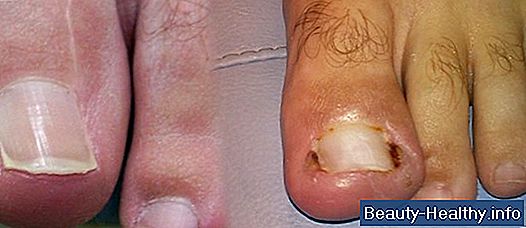 Cómo tratar las uñas encarnadas con remedios caseros