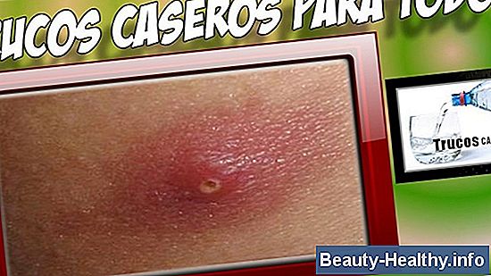 C贸mo tratar una ebullici贸n debajo de un brazo