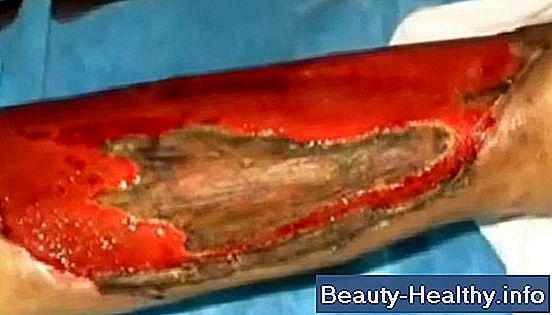 C贸mo tratar una quemadura de cuerda realmente mala