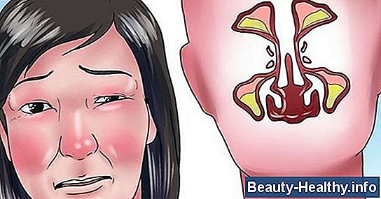 C贸mo usar un aerosol nasal esteroide durante un resfriado