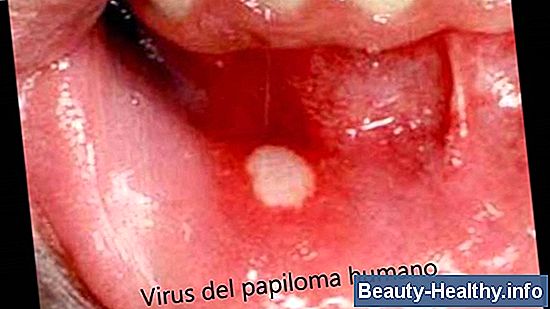 Cómo verificar si hay síntomas de cáncer de garganta