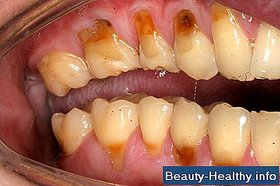 Condiciones médicas que pueden causar dientes frágiles