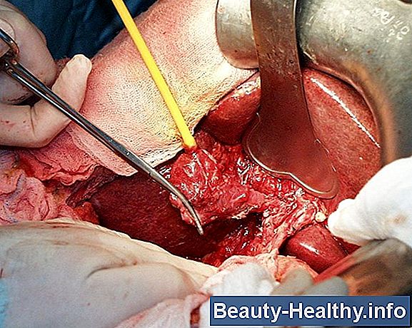Cuidados postoperatorios para dentaduras inmediatas