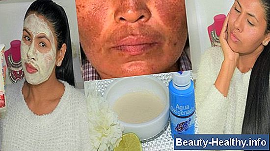 ¿Cuáles son las manchas blancas en la piel por la exposición al sol?