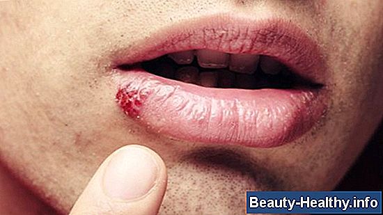 ¿Cuándo ya no es contagioso el herpes labial?