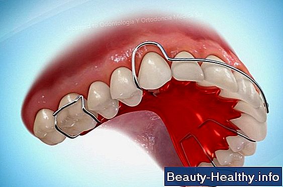 ¿Cuánto cuesta una dentadura superior completa?