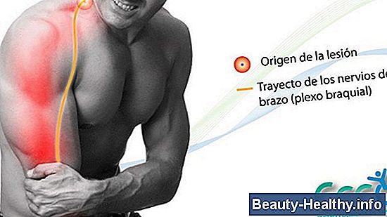 Diferencias entre la Radiculopatía Cervical y el Síndrome del Túnel del Carpo