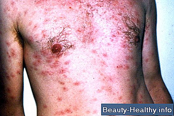 Etapas de Poison Ivy Rash