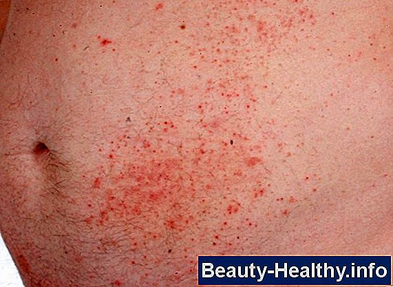 Etapas de Tinea Versicolor