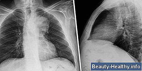 Fiebre glandular en adultos