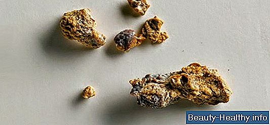 ¿Las piedras en los riñones causan estreñimiento?