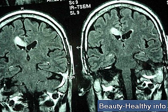 Parkinsonismo frente a la enfermedad de Parkinson