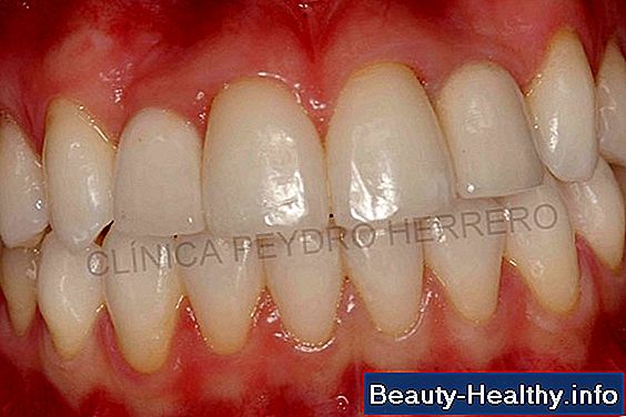Per贸xido de hidr贸geno y el tratamiento de la psoriasis