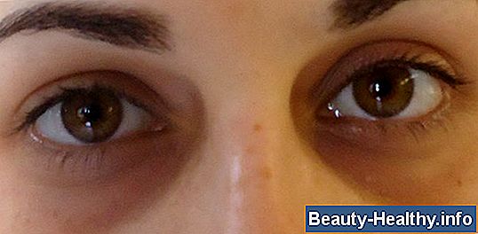 ¿Por qué los vasos sanguíneos estallan en los ojos?