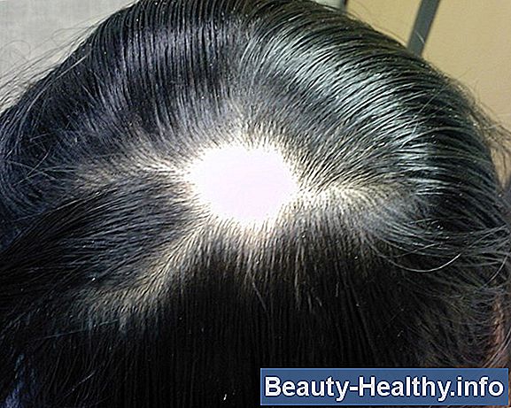 Pérdida de cabello debido a rosácea