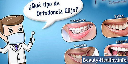 Pros y contras de los implantes dentales