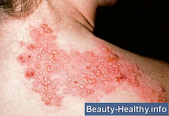 驴Puede la culebrilla estar en ambos lados del cuerpo?