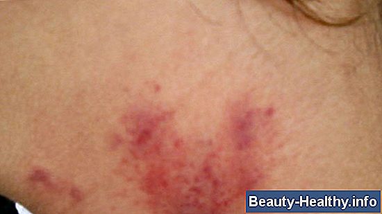 驴Puedes tener herpes z贸ster dentro de tu cuerpo?