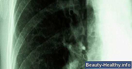 ¿Qué causa el tejido cicatricial en los pulmones?