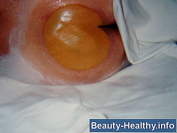 ¿Qué es la cicatrización apical?