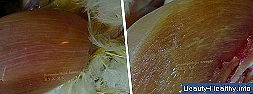 ¿Qué es la miopatía esteroidea?