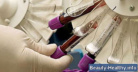 ¿Qué es RDW en un análisis de sangre?