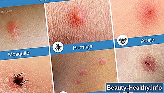 ¿Qué se puede aplicar para prevenir las picaduras de hormigas?