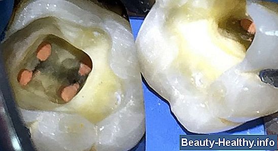 ¿Qué sucede si los dientes podridos se dejan desatendidos?