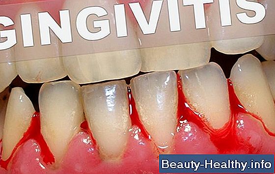 Remedios caseros para las enc铆as doloridas de las dentaduras