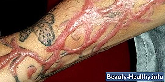 Salabrasion para eliminar tatuajes