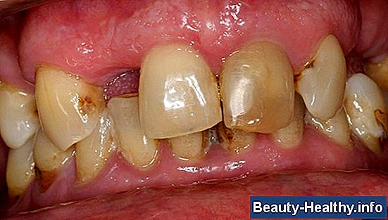 Signos de infecci贸n de implantes dentales