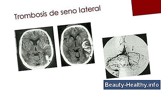 Signos y síntomas de la deshidratación cerebral