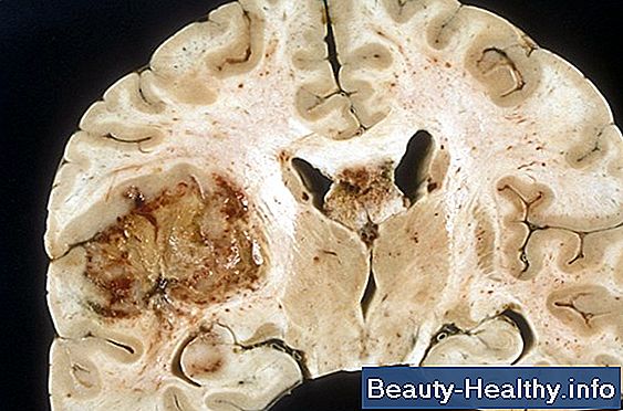 Signos y síntomas del tumor cerebral del tálamo
