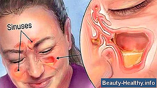 Síntomas de altos niveles de testosterona en los hombres