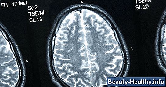 S铆ntomas de la enfermedad cerebral de la materia blanca